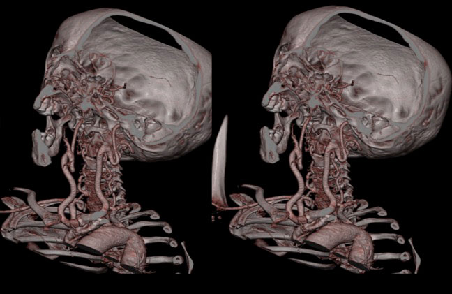 Tortuous Carotid Arteries